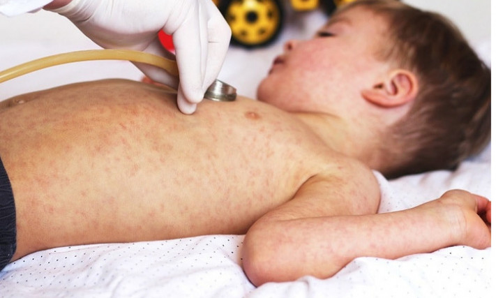 Trẻ bị sốt rubella cần làm gì? Dấu hiệu và cách xử lý như thế nào?