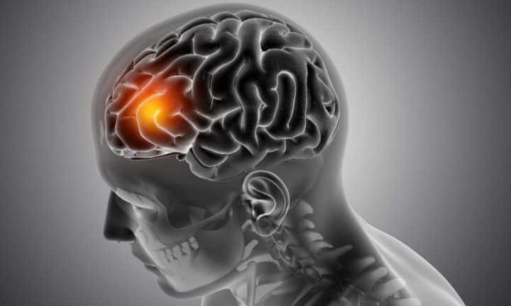 Alzheimer làm tăng nguy cơ mắc COVID-19 nghiêm trọng và tử vong