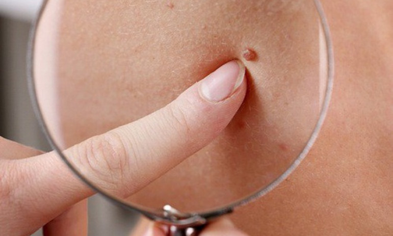 Loại ung thư có khả năng chữa khỏi gần 100% nếu phát hiện sớm