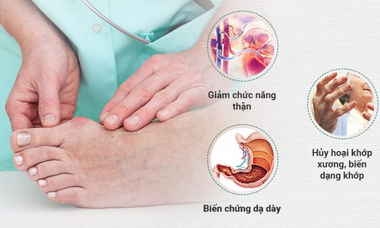 7 cách “chung sống hòa bình” với bệnh gout