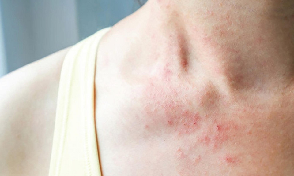 Thuốc điều trị viêm da dị ứng