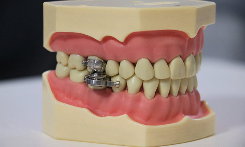 Độc lạ thiết bị giảm cân ngăn người đeo mở miệng để nhai