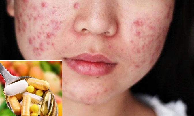 Sử dụng thuốc kháng sinh lâu dài trị mụn trứng cá có thúc đẩy kháng thuốc?
