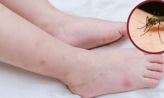 Cách xử lý vết muỗi đốt