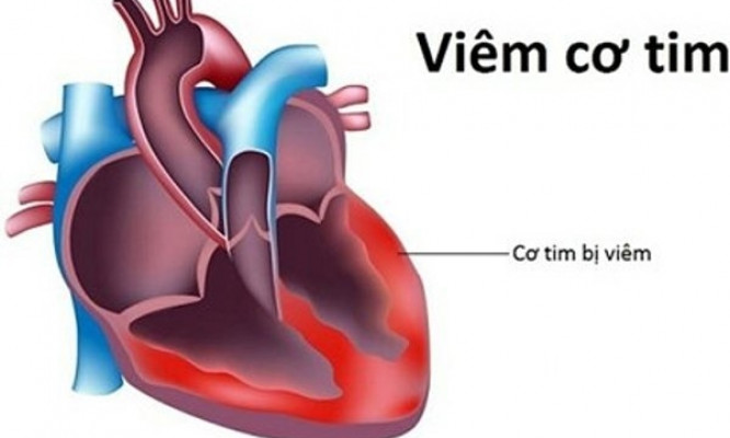 Viêm cơ tim sau tiêm vaccine COVID-19: Chẩn đoán, điều trị thế nào?