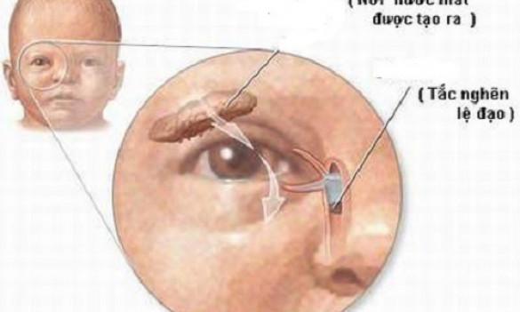 Giúp mẹ nhận biết tắc tuyến lệ ở trẻ sơ sinh sớm nhất