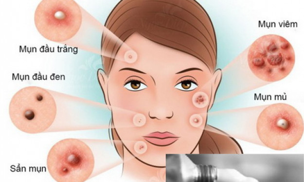 Thêm một lựa chọn điều trị cho người bị mụn trứng cá