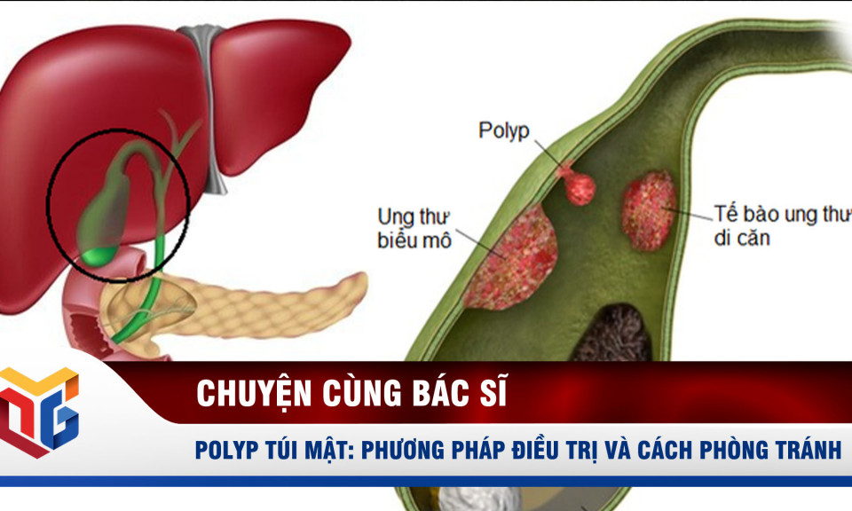 Polyp túi mật: Phương pháp điều trị và cách phòng tránh