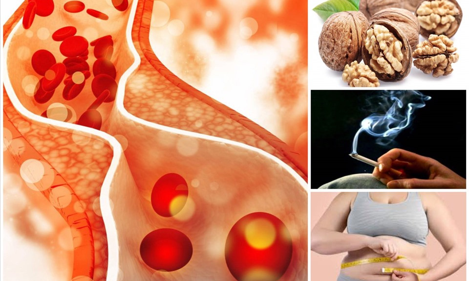 Nguyên nhân tắc nghẽn mạch máu và cách giúp bạn ngăn ngừa