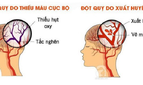 Cách xử trí các ca bệnh đột quỵ cấp liên quan tới COVID-19