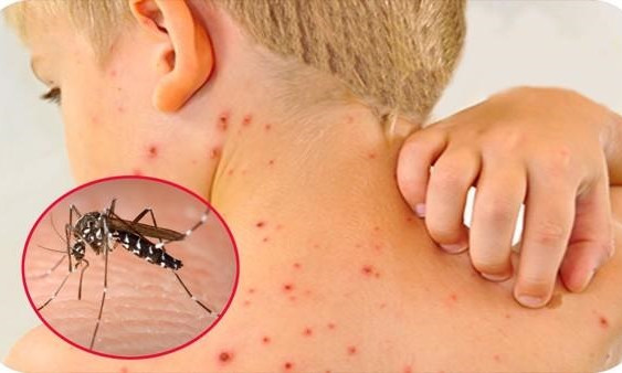 5 loại bệnh dễ phát triển vào mùa mưa