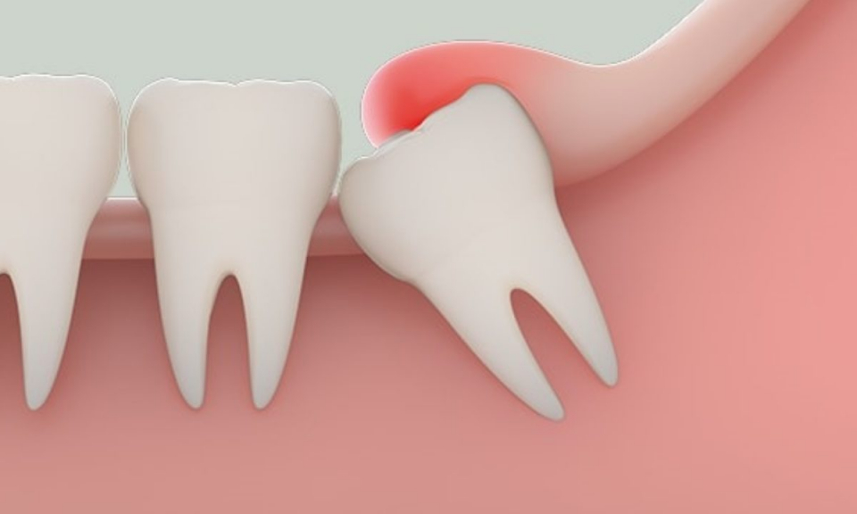 Chuyện cùng bác sĩ: Những điều cần biết về răng khôn