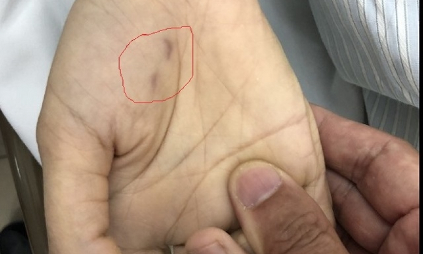 Chết do bệnh dại sau hai năm bị chó cắn