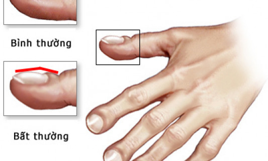 Dấu hiệu ở ngón tay cảnh báo ung thư phổi