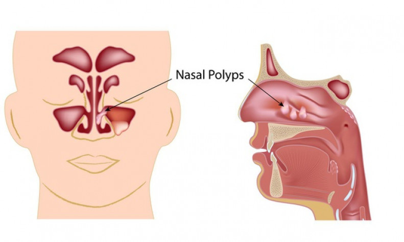 Polyp mũi: Triệu chứng và cách phòng ngừa