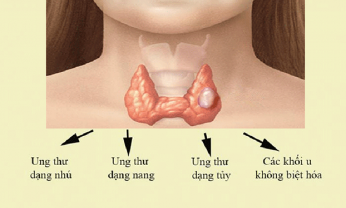  Ung thư tuyến giáp: Sự phát triển của khối u và khả năng di căn