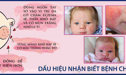 Chàm sữa ở trẻ em: Phân loại và xử trí đúng, giải tỏa nỗi lo khi mùa đông về