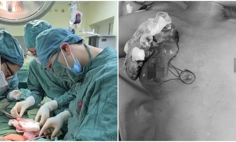 Khối u vú căng phồng, lở loét do bệnh nhân không đi khám bệnh