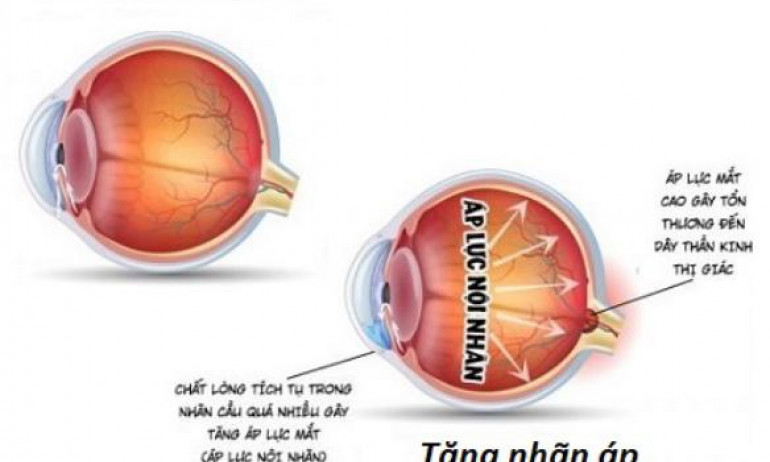 Thực phẩm tốt cho người bệnh tăng nhãn áp