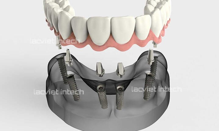 Trồng răng Implant All on 6: Xóa bỏ nỗi lo mất răng toàn hàm