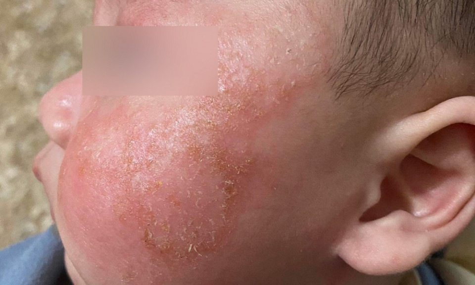Kiêng tắm 6 ngày khi mắc Covid-19, da trẻ đóng vảy, đỏ lừ