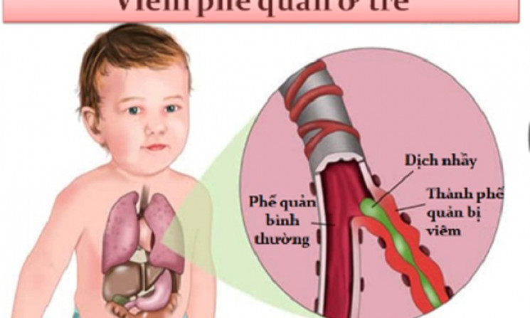 Nguyên nhân khiến trẻ hay mắc viêm phế quản và cách chăm sóc đúng