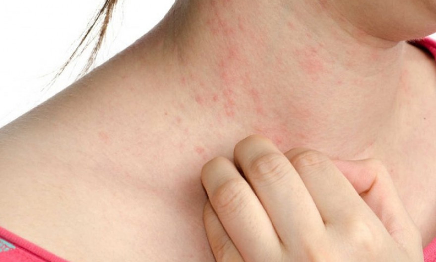 Dị ứng thời tiết có thể ảnh hưởng đến bạn như thế nào?