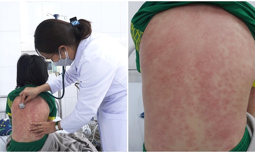 Phát hiện 2 trẻ mắc hội chứng MIS-C hiếm gặp liên quan đến Covid-19