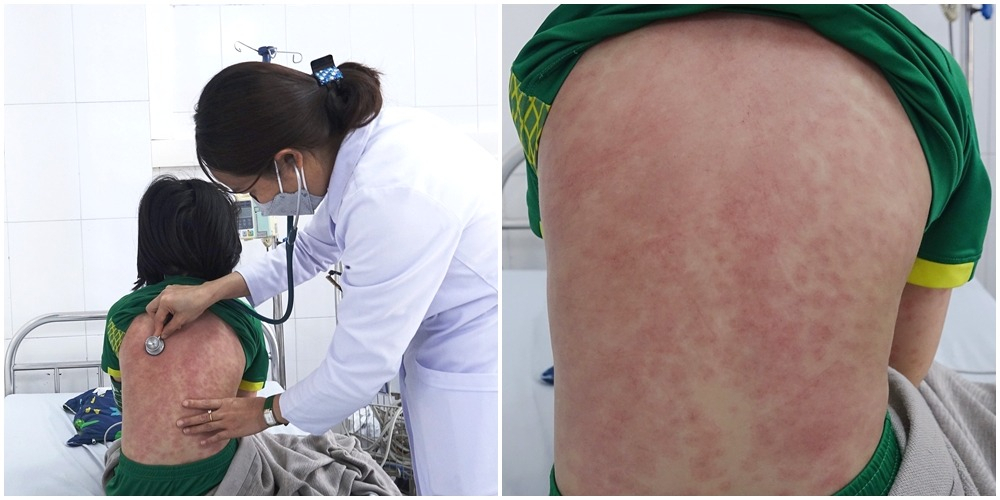 Bác sĩ Bệnh viện Bãi Cháy khám cho trường hợp bệnh nhi mắc hội chứng MIS-C hiếm gặphậu Covid-19. Ảnh: Minh Khương (CDC tỉnh).
