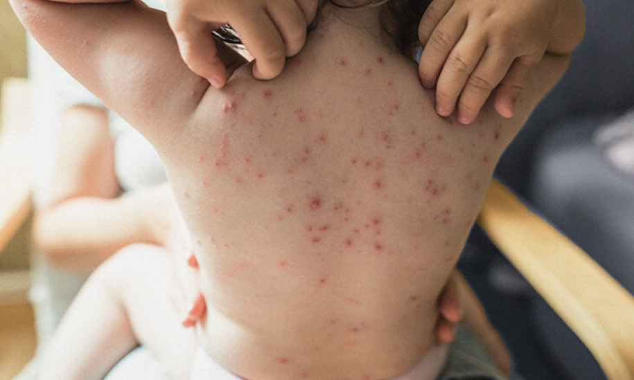 Bệnh thủy đậu vào mùa và những lưu ý khi dùng thuốc
