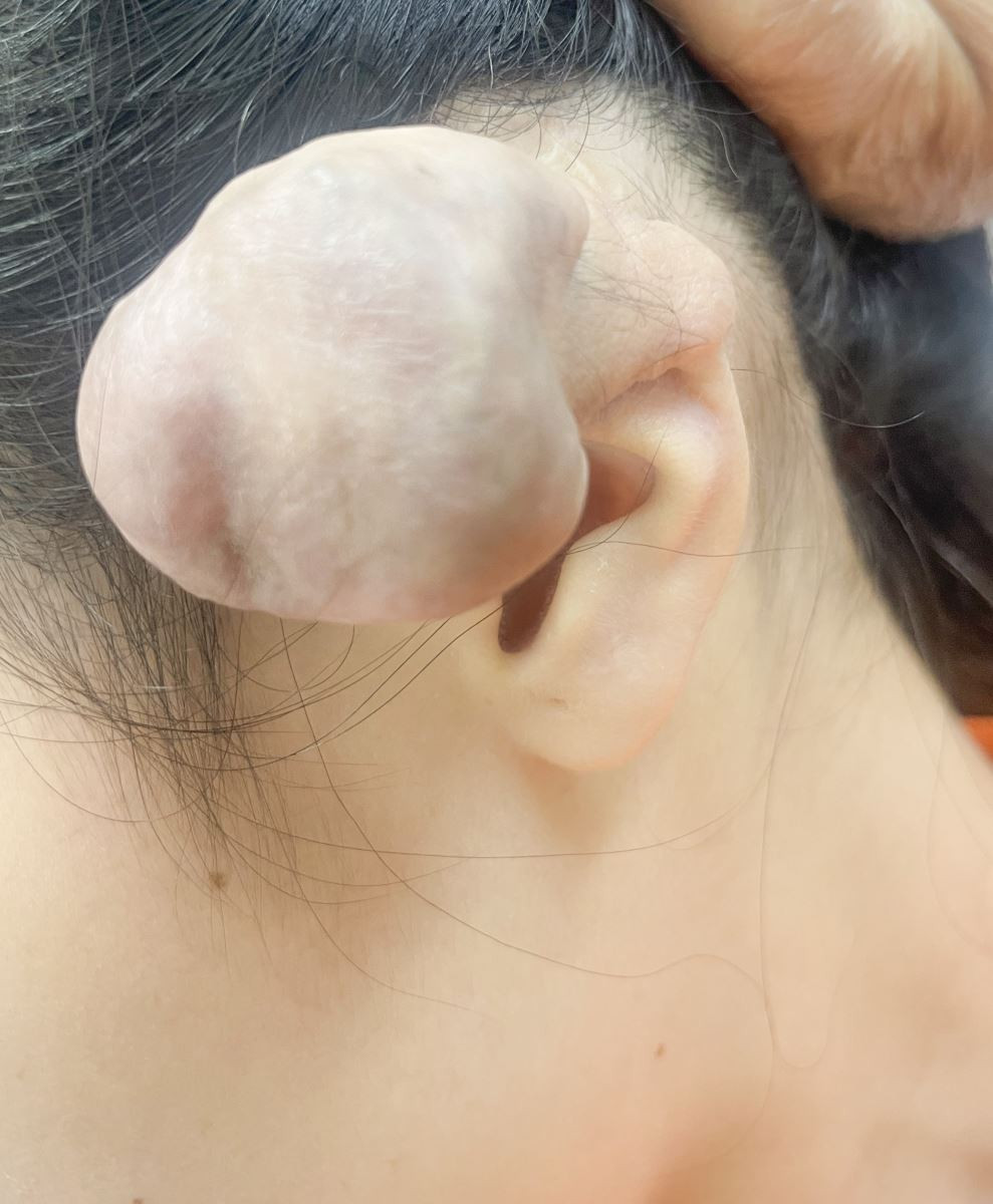 Bấm lỗ tai có đau không? Bấm lỗ tai ở sụn có đau không?