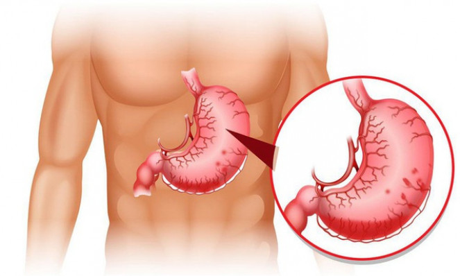 Điểm mặt các dấu hiệu bất thường về đau dạ dày cần tới bác sĩ
