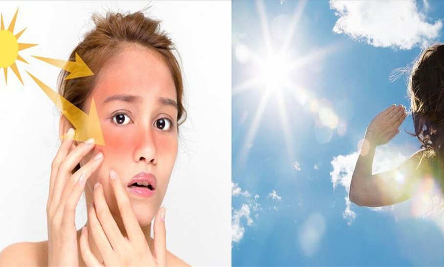 4 cách bảo vệ da nhạy cảm tránh khỏi ánh nắng mặt trời