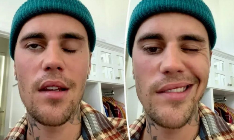 Justin Bieber bị liệt nửa mặt do hội chứng hiếm gặp