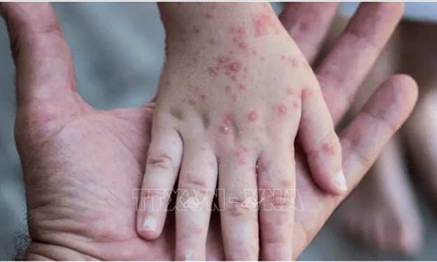 Singapore xác nhận một ca bệnh đậu mùa khỉ 'nhập cảnh'