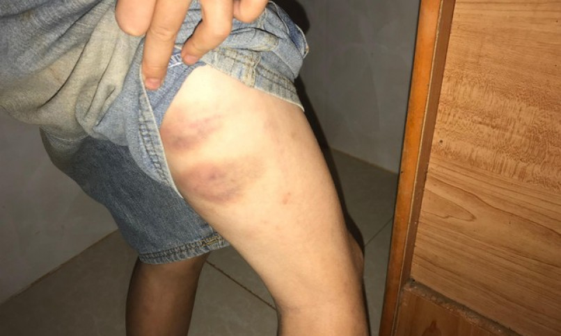 Bé trai 9 tuổi vết thương đầy người, nghi bị bố và bà nội bạo hành