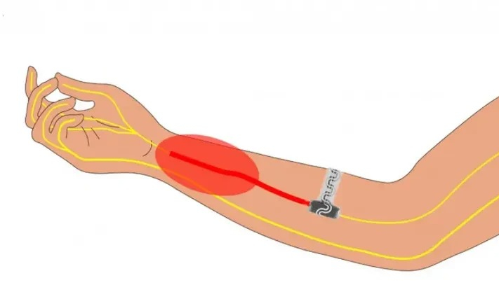 Thiết bị đột phá mới giúp giảm đau mà không cần thuốc