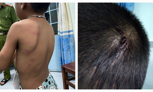 Bé trai 6 tuổi bị cha ruột hành hạ, đánh đập dã man