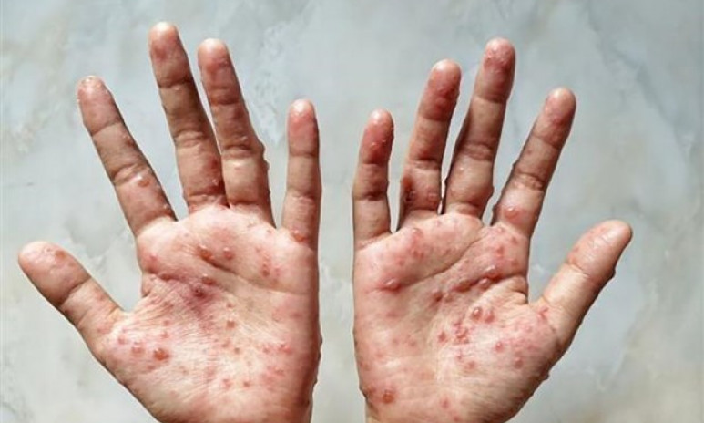 WHO ban bố tình trạng khẩn cấp y tế toàn cầu đối với bệnh đậu mùa khỉ