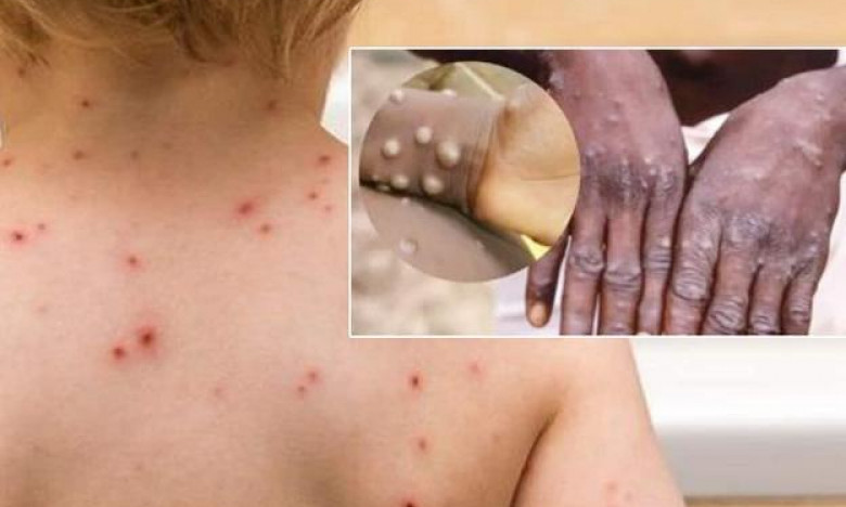 Sáng 25/7: Tiếp tục giám sát sự lưu hành của biến thể phụ BA.4, BA.5; đã có vaccine phòng đậu mùa khỉ thế hệ mới