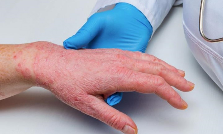 Mỹ: Bệnh đậu mùa khỉ lây lan, New York ban bố tình trạng khẩn cấp