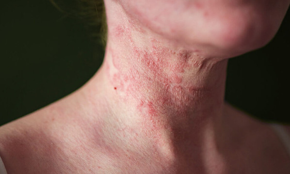 Viêm da dị ứng có thể ảnh hưởng đến sức khỏe tâm thần ra sao?