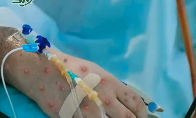 Nóng: Bệnh nhân đầu tiên mắc đậu mùa khỉ tại Việt Nam là nữ, khởi phát bệnh khi đang đi du lịch