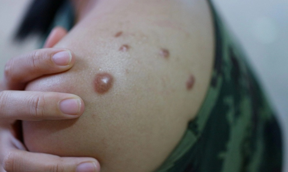 Cách ngăn ngừa sẹo do bệnh đậu mùa khỉ gây ra