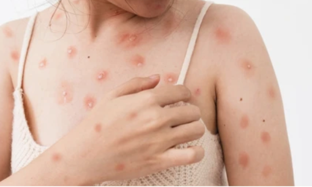 Chăm sóc và điều trị đậu mùa khỉ thế nào?