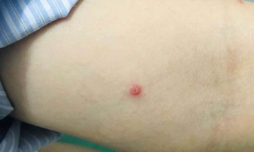 Các mức độ của bệnh đậu mùa khỉ