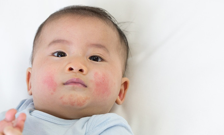 Bệnh phổ biến ở trẻ em nhưng thường nhầm sang bệnh khác