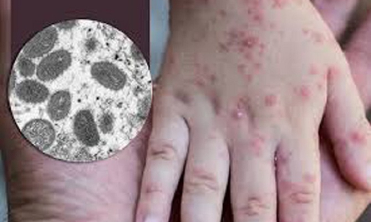 Cẩn trọng với bệnh đậu mùa khỉ