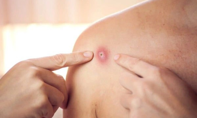 Bộ Y tế đưa đậu mùa khỉ vào bệnh truyền nhiễm nhóm B