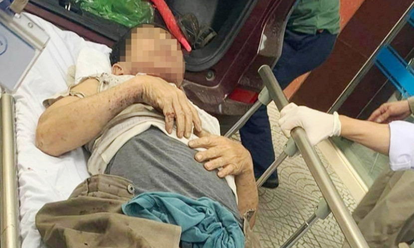 Thùng phuy dầu phát nổ, một Giám đốc doanh nghiệp bị thương nặng